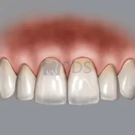 Chu’s Aesthetic Gauge BLPG Replacement Tips (3 Tips) Hu-Friedy BLPGREF