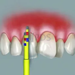 Inline Replacement Tips (3 Tips) Hu-Friedy INLINEREF